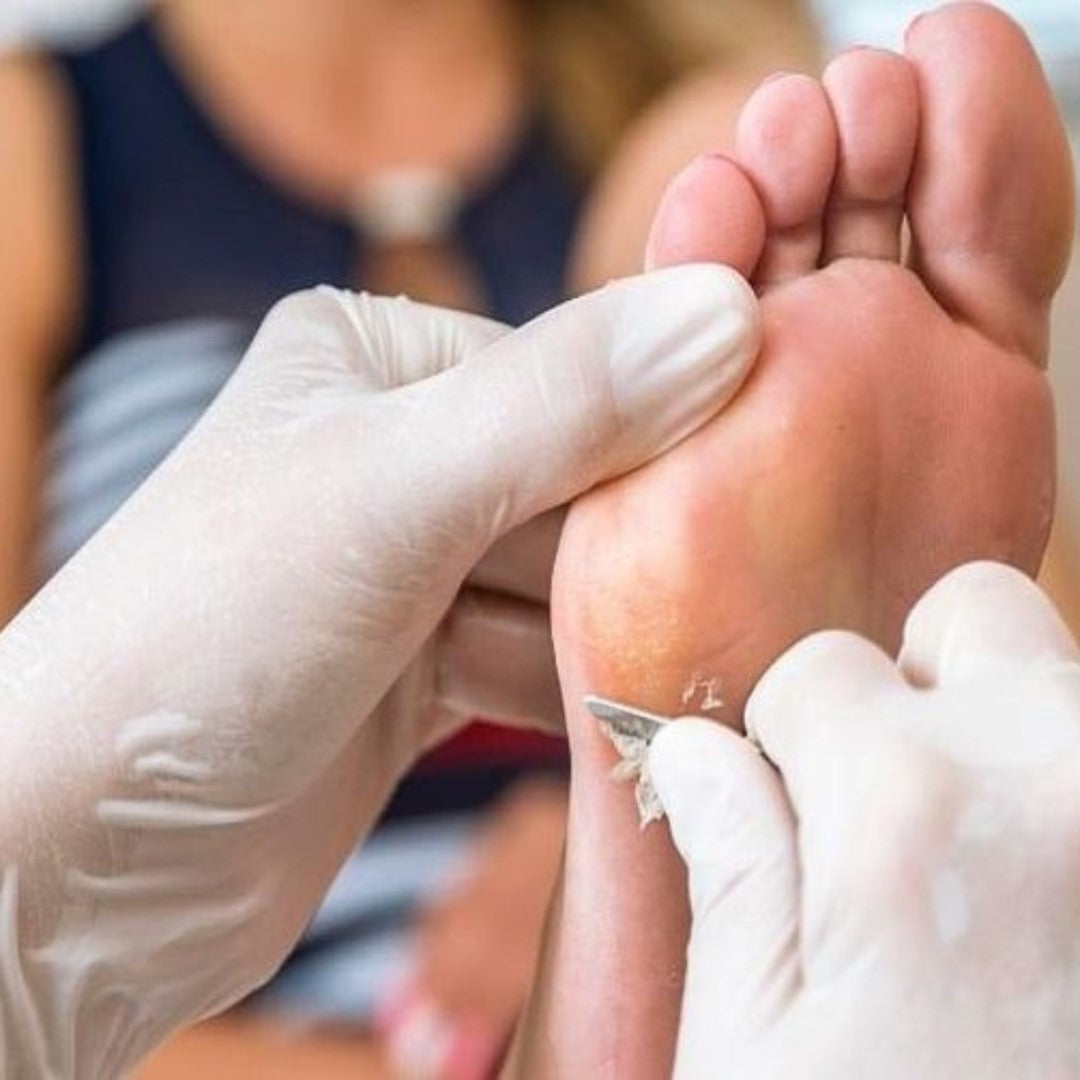 Professional callus removal treatment to maintain healthy feet, focusing on gently exfoliating rough patches and promoting smooth, soft skin. Ideal for in-between appointments at Casa D'Blanca Nails + Spa in Grimsby on the Lake.